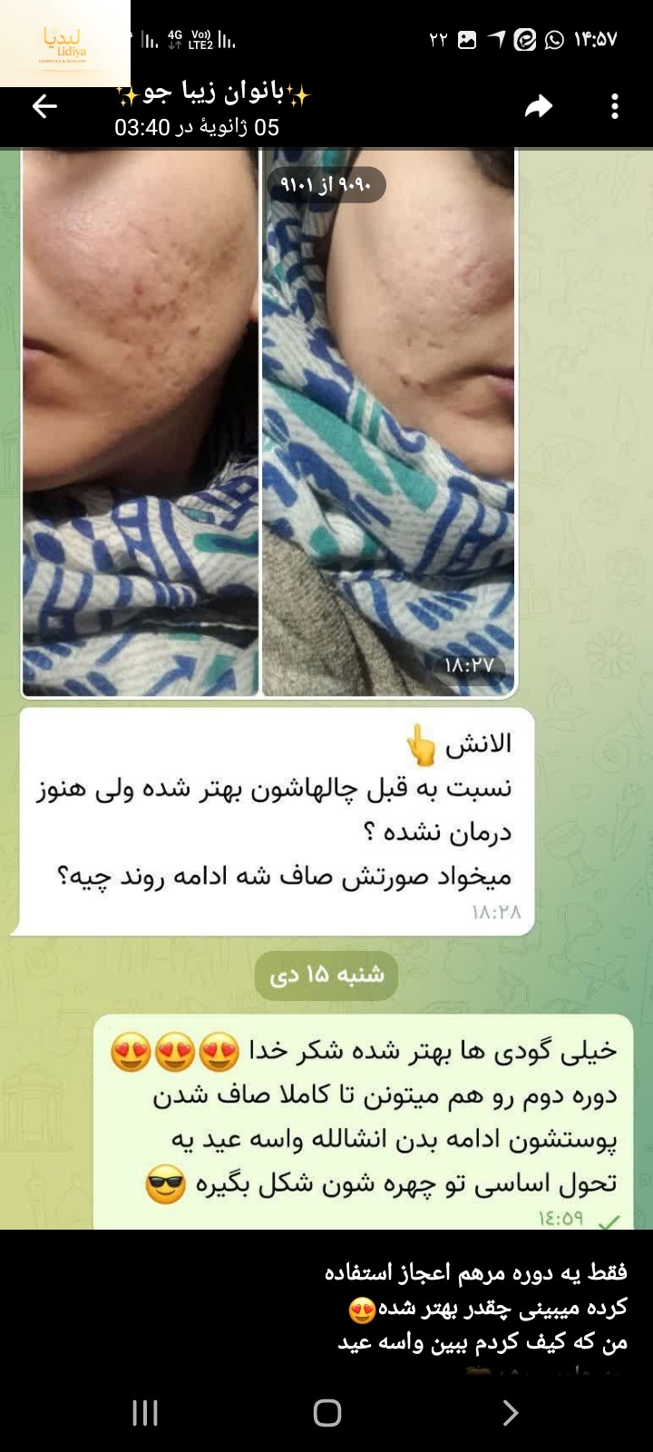 کرم ترمیم کننده جای جوش و زخم و بخیه مرهم اعجاز 30 میل   🌈حاوی خاویار حلزون وکشته مروارید(اشانتیون کرم کلاژن ساز قوی 40 میل  )